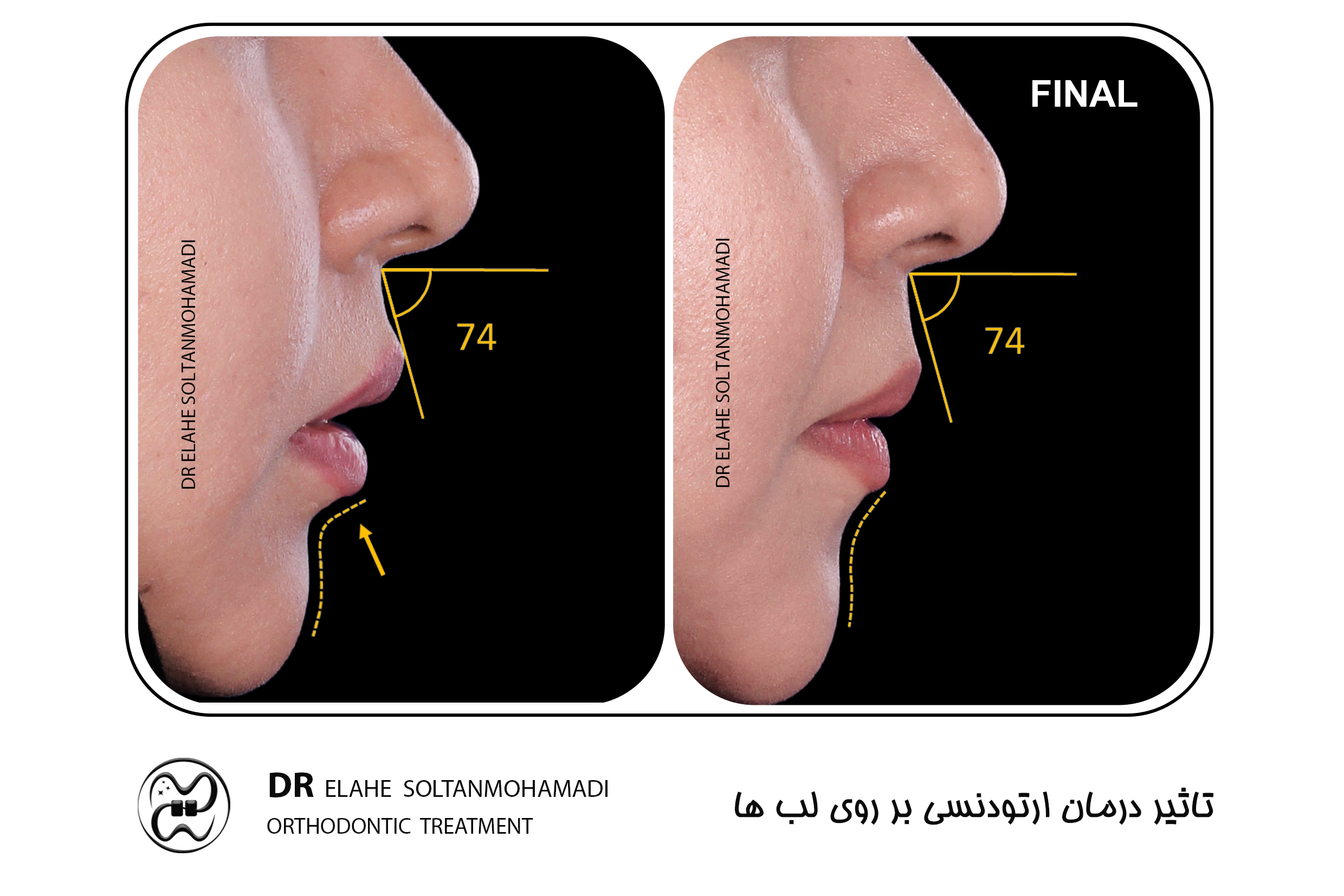 اصلاح فرم لب ها